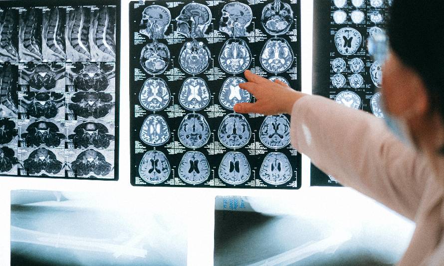 Accidente cerebrovascular: Las primeras horas son cruciales para una óptima recuperación